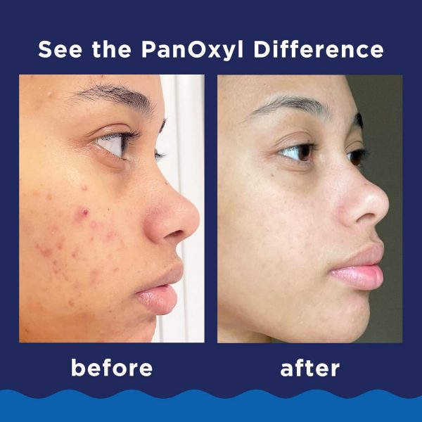 PANOXYL ACNE FOAMING WASH 10% BENZOYL PEROXIDE - Image 2